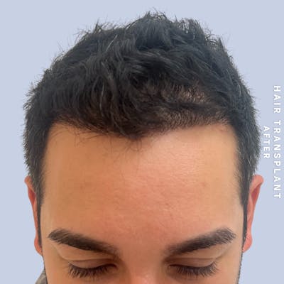 Men's Hair Before & After Gallery - Patient 271697 - Image 2