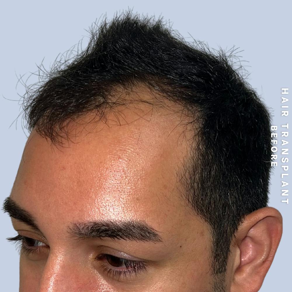 Men's Hair Before & After Gallery - Patient 271697 - Image 3