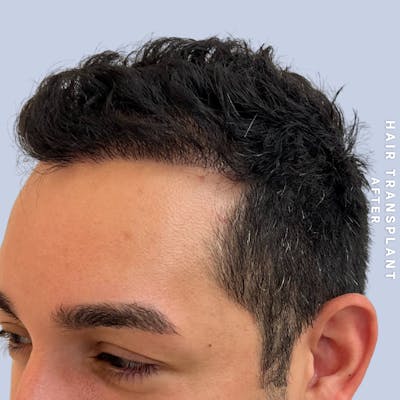 Men's Hair Before & After Gallery - Patient 271697 - Image 4