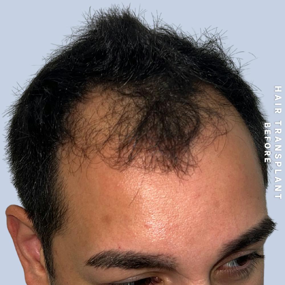 Men's Hair Before & After Gallery - Patient 271697 - Image 5