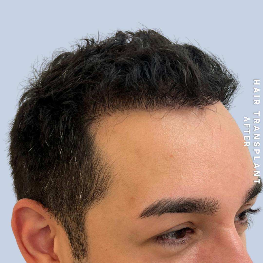 Men's Hair Before & After Gallery - Patient 271697 - Image 6