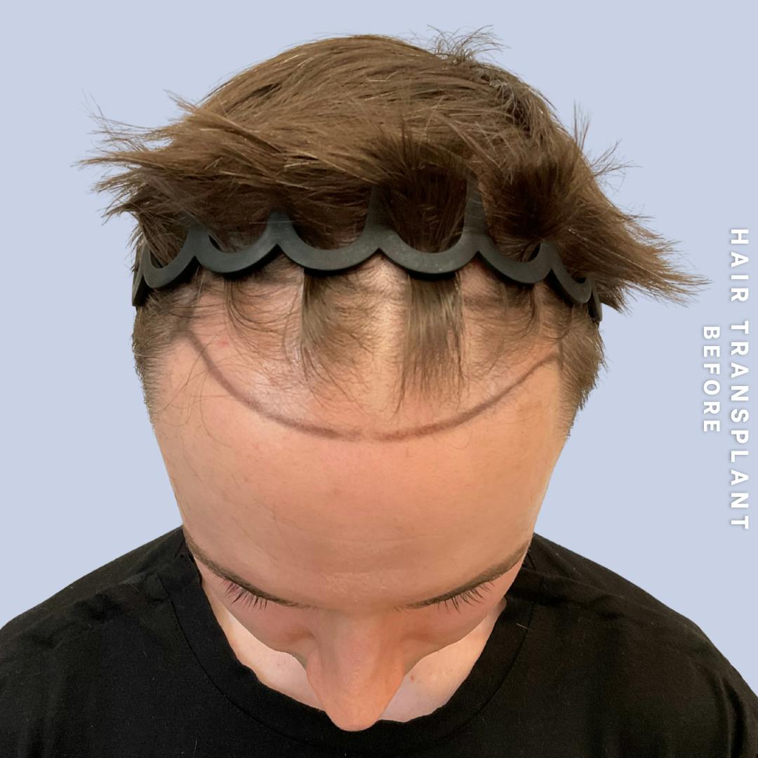 Men's Hair Before & After Gallery - Patient 349652 - Image 1