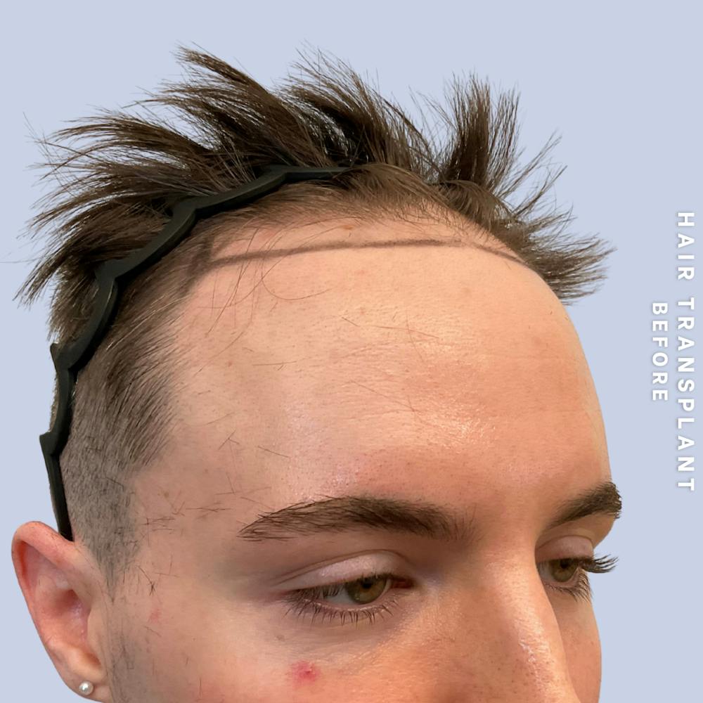 Hair Restoration Before & After Gallery - Patient 362220 - Image 3