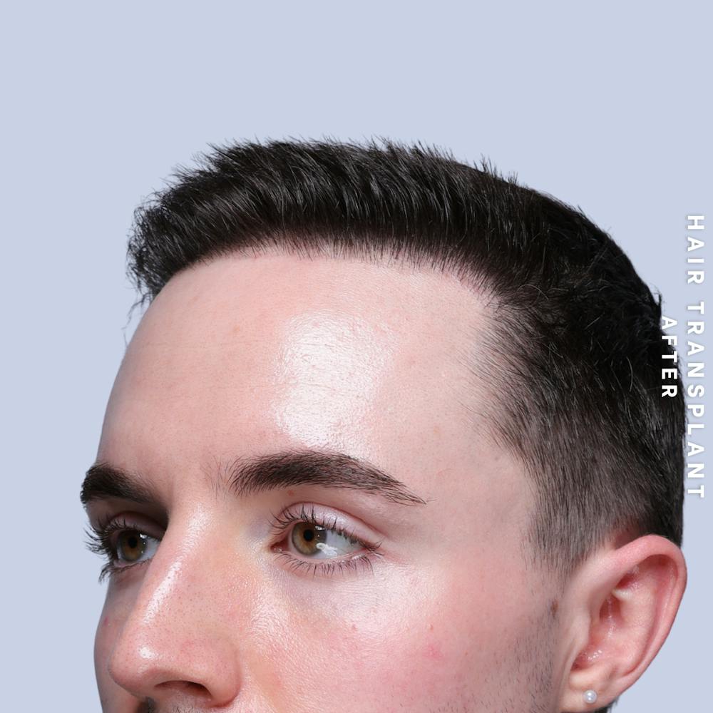 Hair Restoration Before & After Gallery - Patient 362220 - Image 6