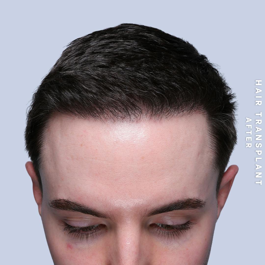 Men's Hair Before & After Gallery - Patient 349652 - Image 2