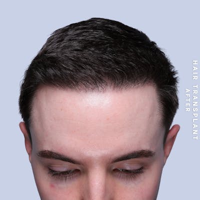 Hair Restoration Before & After Gallery - Patient 362220 - Image 2