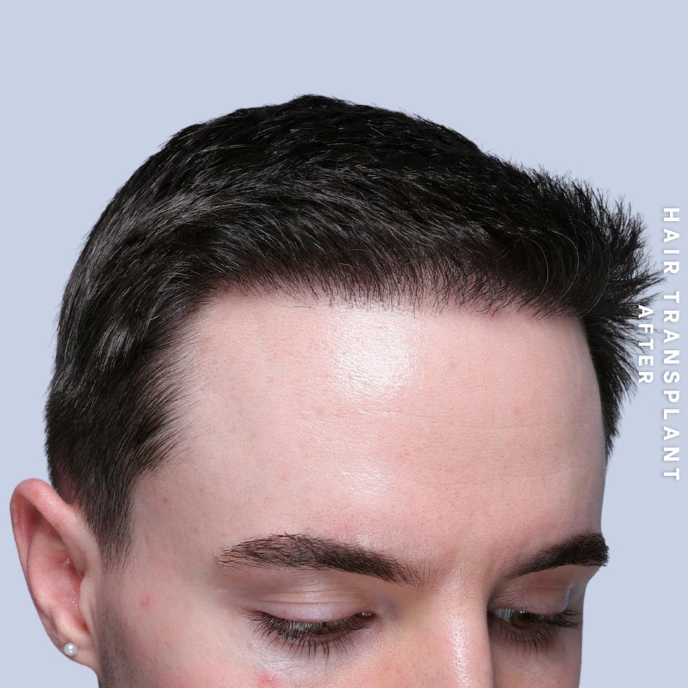 Hair Restoration Before & After Gallery - Patient 362220 - Image 4