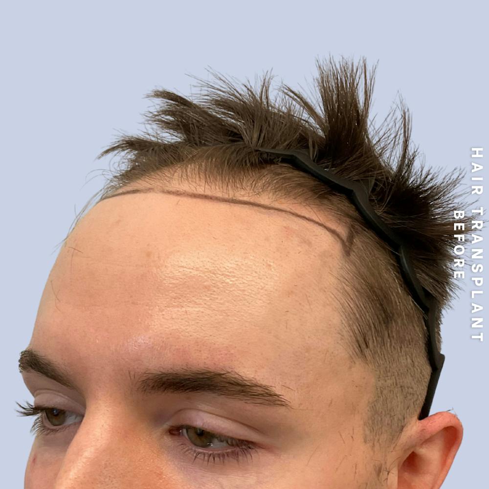 Hair Restoration Before & After Gallery - Patient 362220 - Image 5