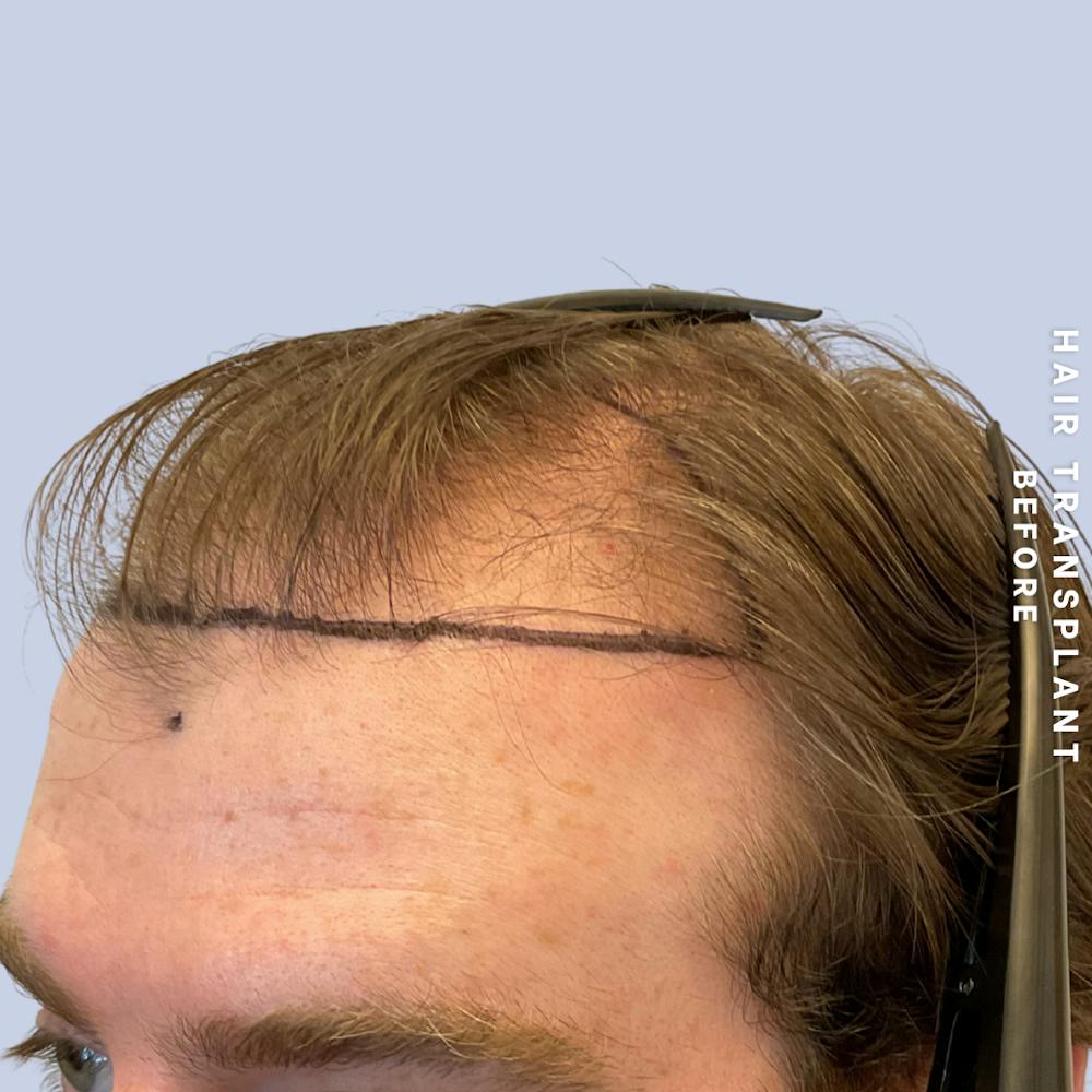 Men's Hair Before & After Gallery - Patient 334489 - Image 5