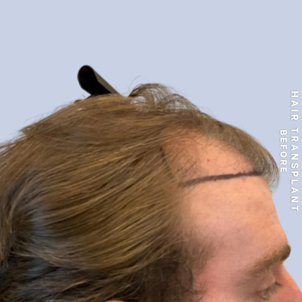 Men's Hair Before & After Gallery - Patient 334489 - Image 7