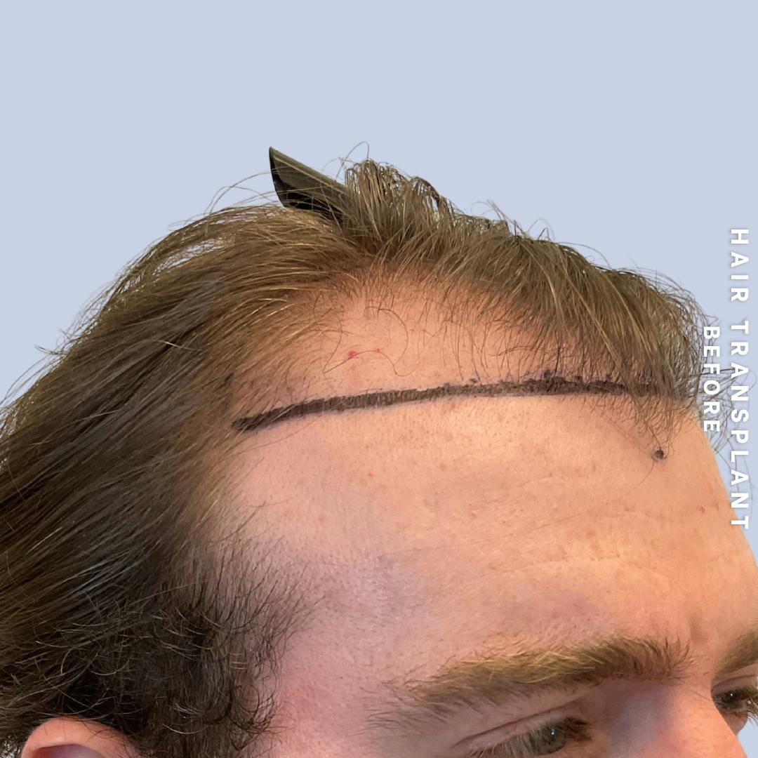 Hair Restoration Before & After Gallery - Patient 294070 - Image 9