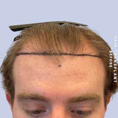 Hair Restoration Before & After Gallery - Patient 294070 - Image 1