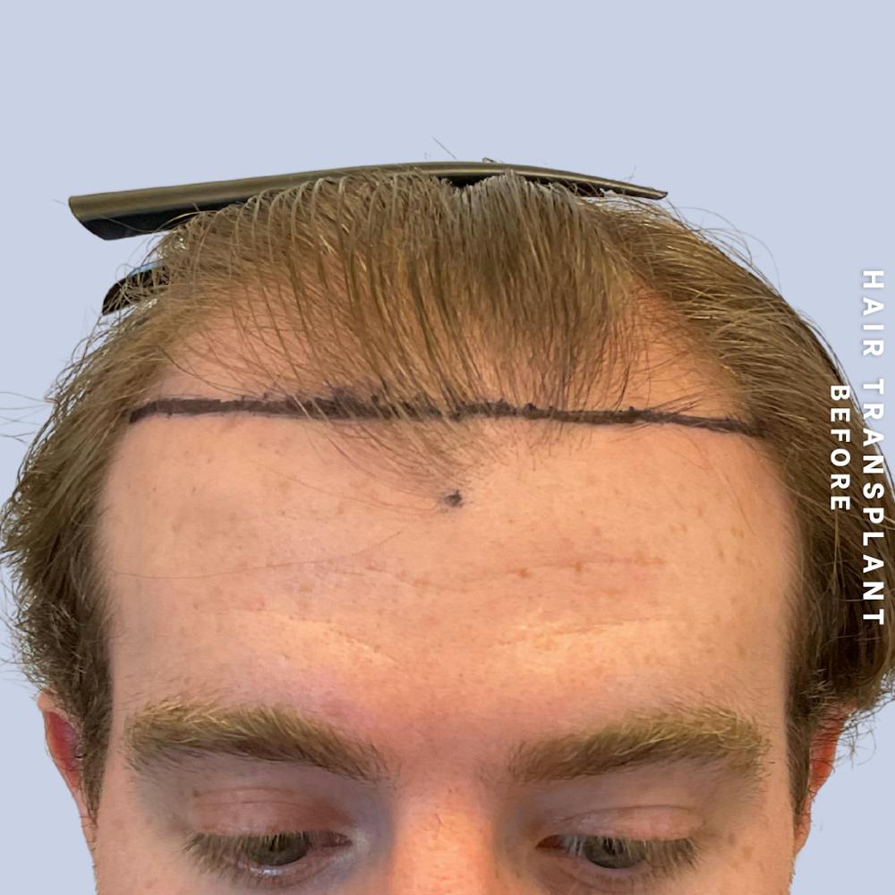 Men's Hair Before & After Gallery - Patient 334489 - Image 1