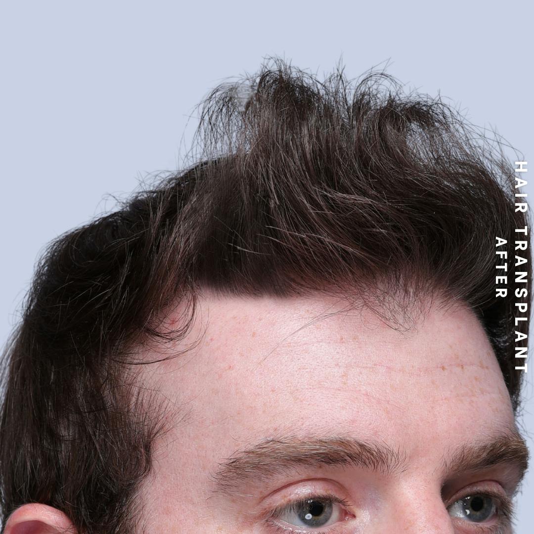 Hair Restoration Before & After Gallery - Patient 294070 - Image 10