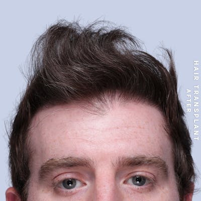 Men's Hair Before & After Gallery - Patient 334489 - Image 2