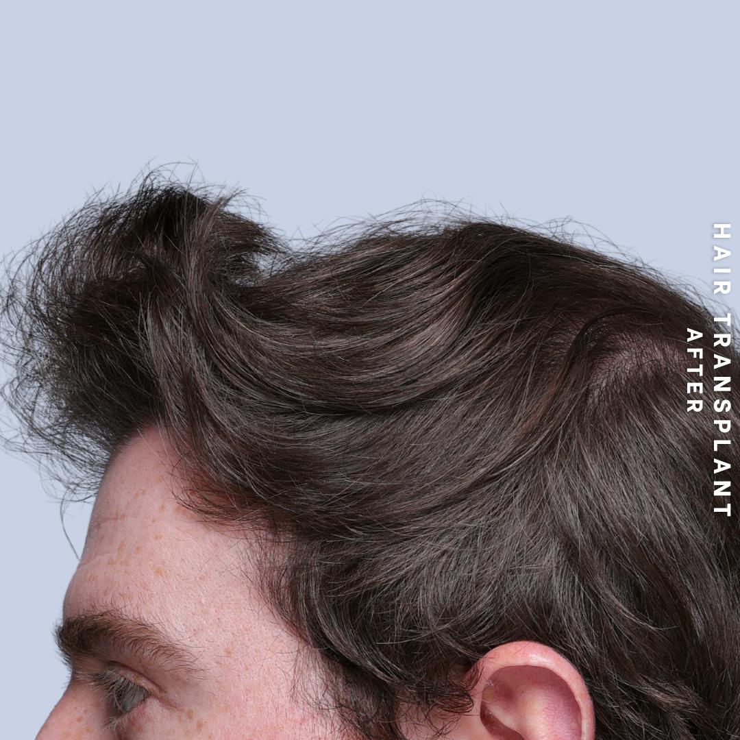 Hair Restoration Before & After Gallery - Patient 294070 - Image 4