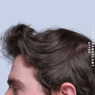 Men's Hair Before & After Gallery - Patient 334489 - Image 4