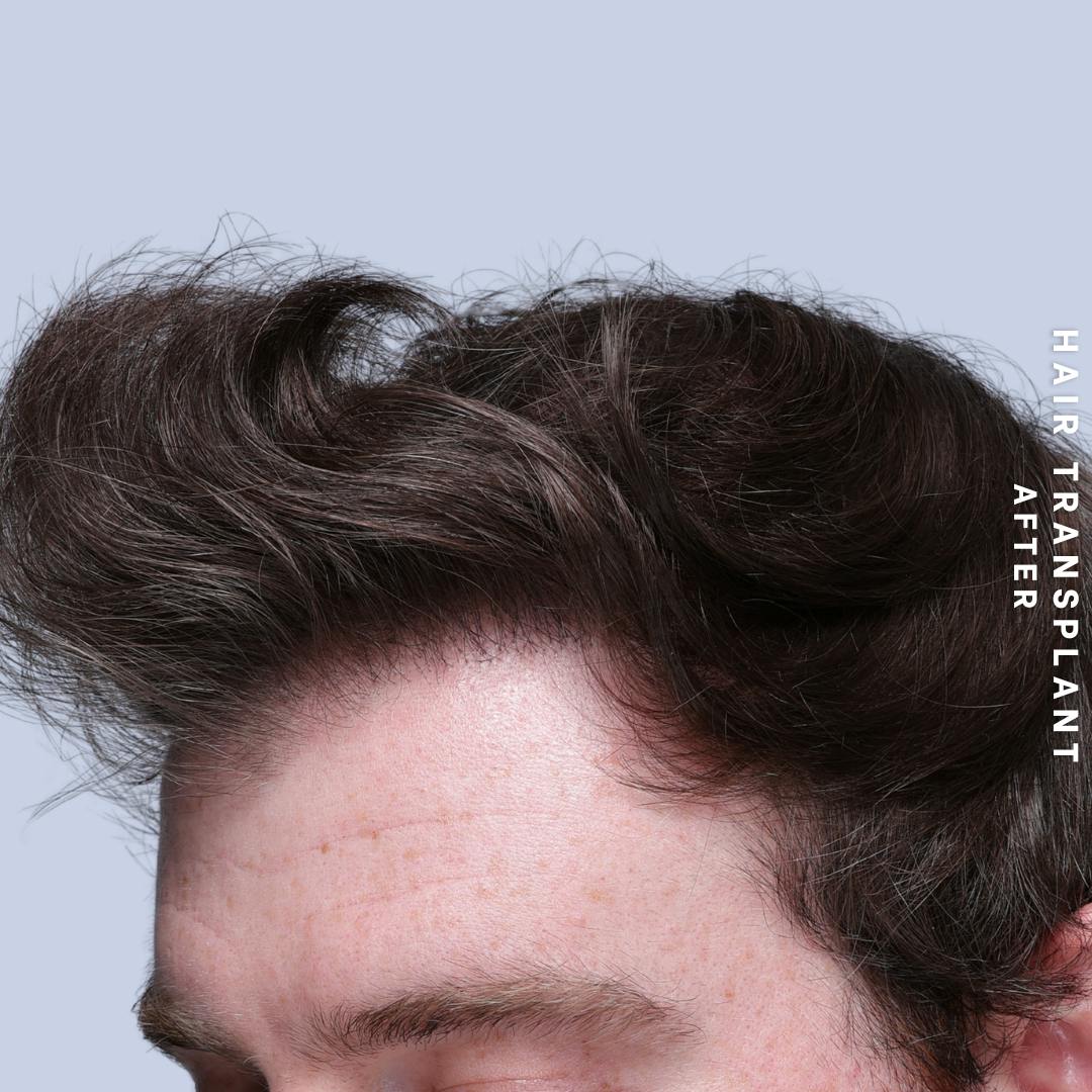 Hair Restoration Before & After Gallery - Patient 294070 - Image 6