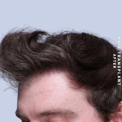 Men's Hair Before & After Gallery - Patient 334489 - Image 6