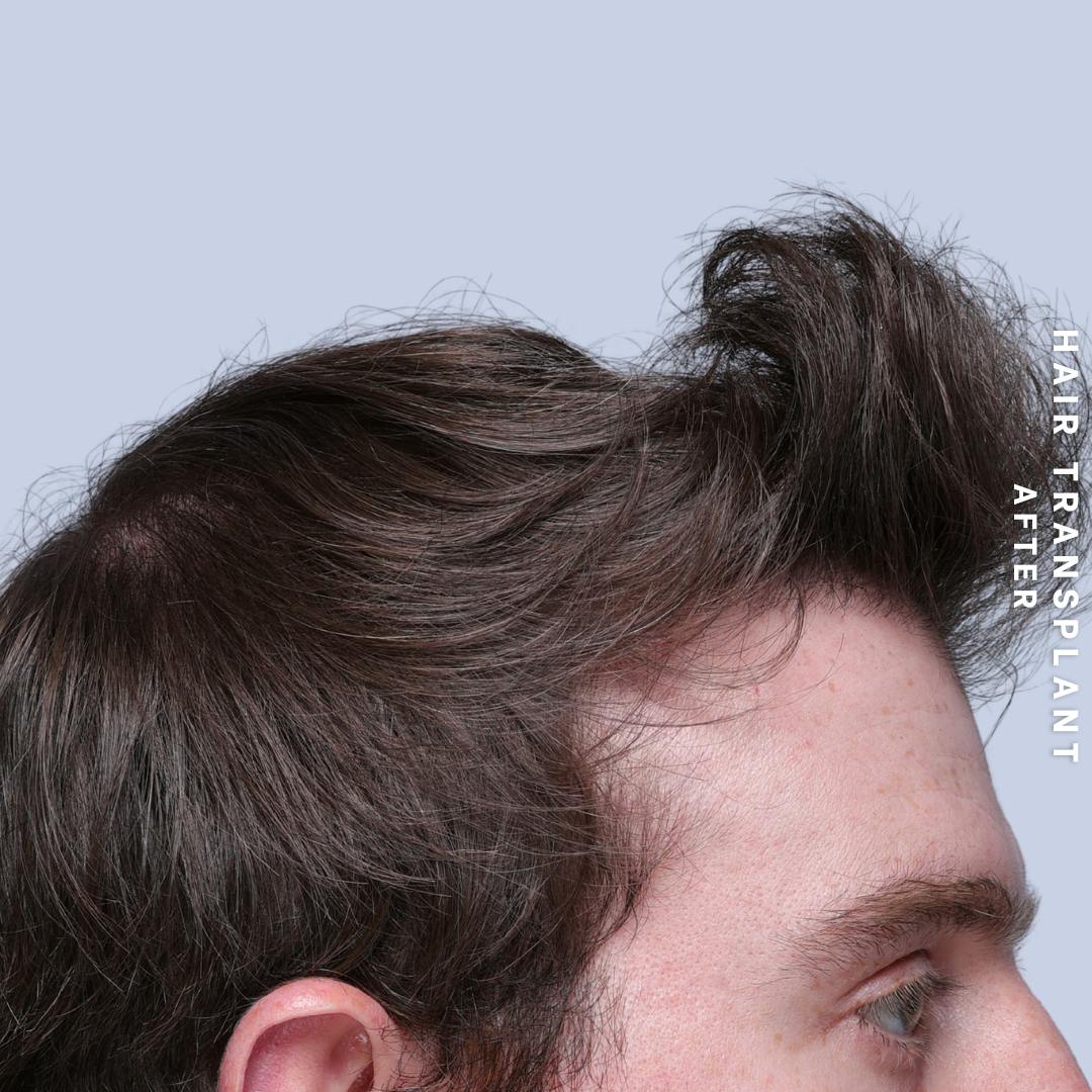 Hair Restoration Before & After Gallery - Patient 294070 - Image 8