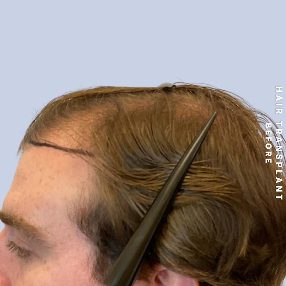 Men's Hair Before & After Gallery - Patient 334489 - Image 3