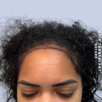 Hair Restoration Before & After Gallery - Patient 109913 - Image 1