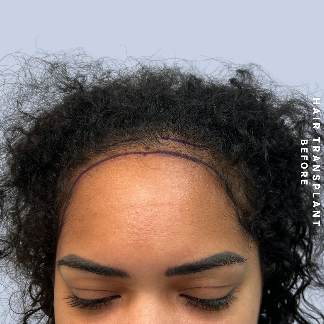 Hair Restoration Before & After Gallery - Patient 109913 - Image 1