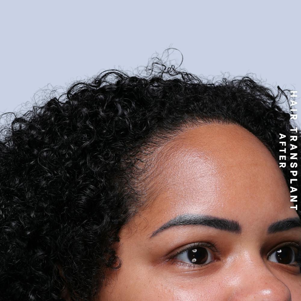 Hair Restoration Before & After Gallery - Patient 109913 - Image 10