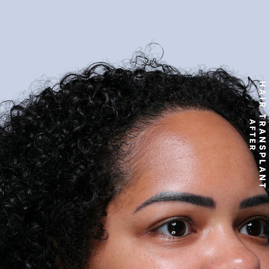 Hair Restoration Before & After Gallery - Patient 109913 - Image 10