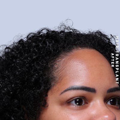 Hair Restoration Before & After Gallery - Patient 109913 - Image 10