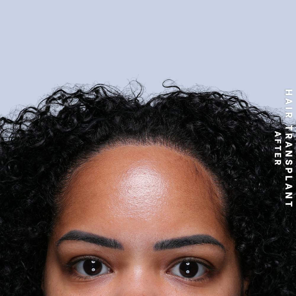 Hair Restoration Before & After Gallery - Patient 109913 - Image 2