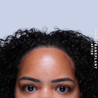 Hair Restoration Before & After Gallery - Patient 109913 - Image 2