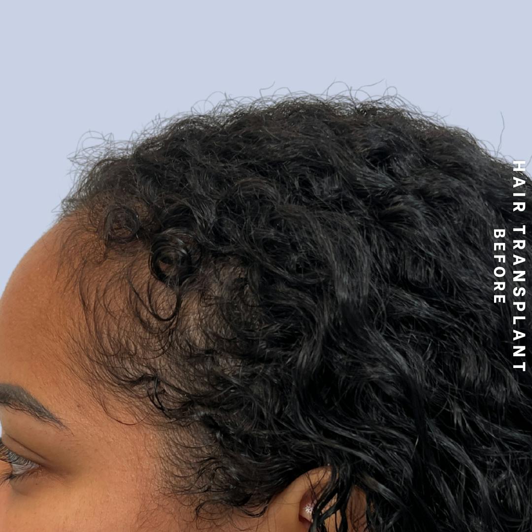 Hair Restoration Before & After Gallery - Patient 109913 - Image 3