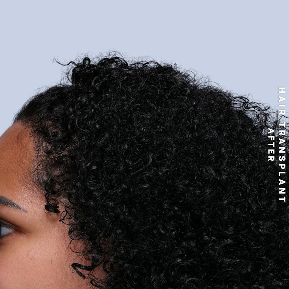 Hair Restoration Before & After Gallery - Patient 109913 - Image 4