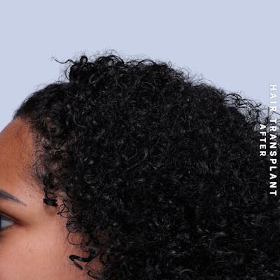 Hair Restoration Before & After Gallery - Patient 109913 - Image 4