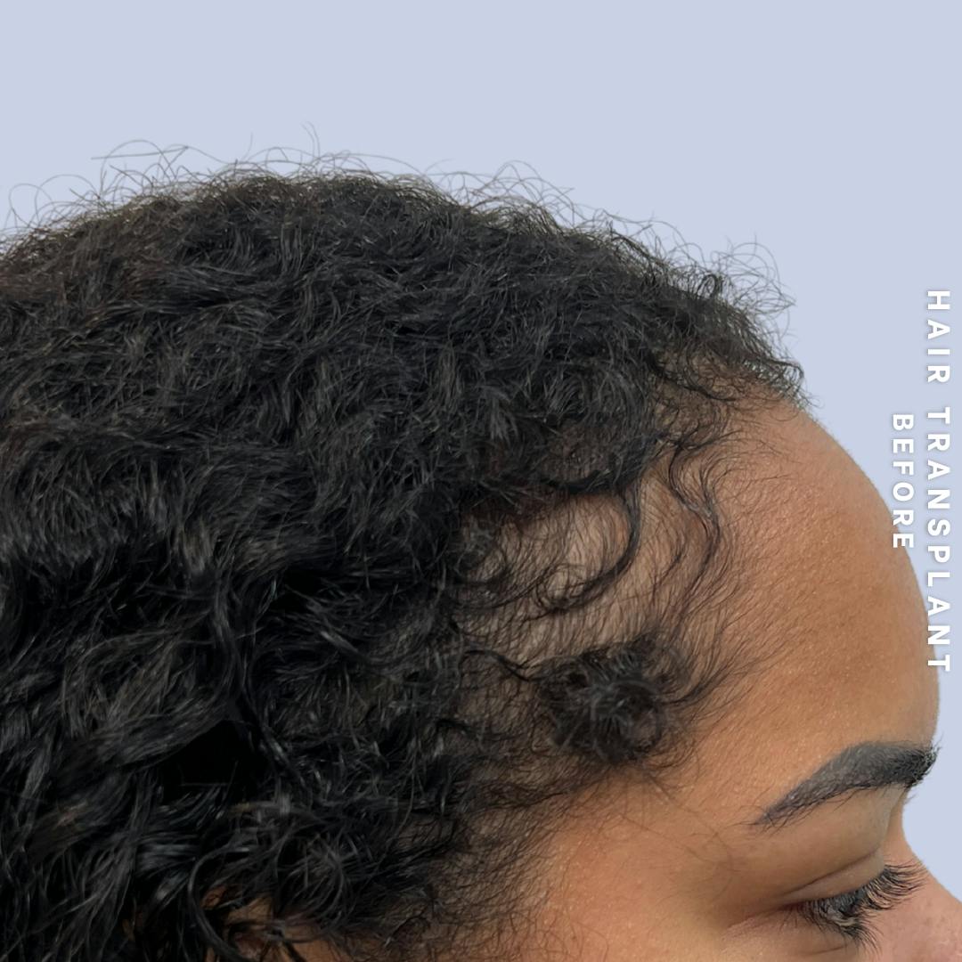 Hair Restoration Before & After Gallery - Patient 109913 - Image 5