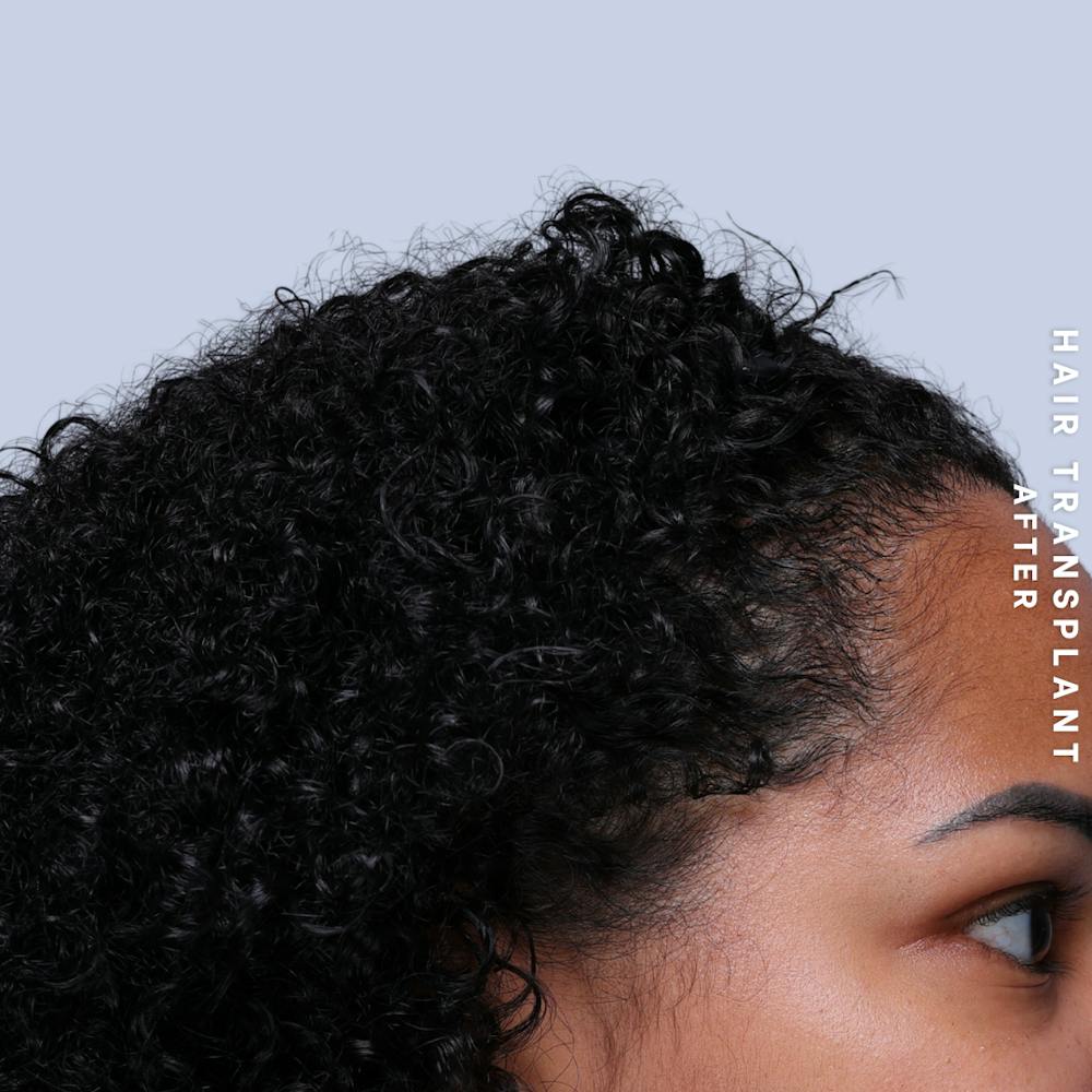 Hair Restoration Before & After Gallery - Patient 109913 - Image 6