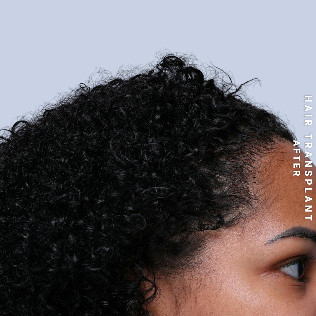 Hair Restoration Before & After Gallery - Patient 109913 - Image 6