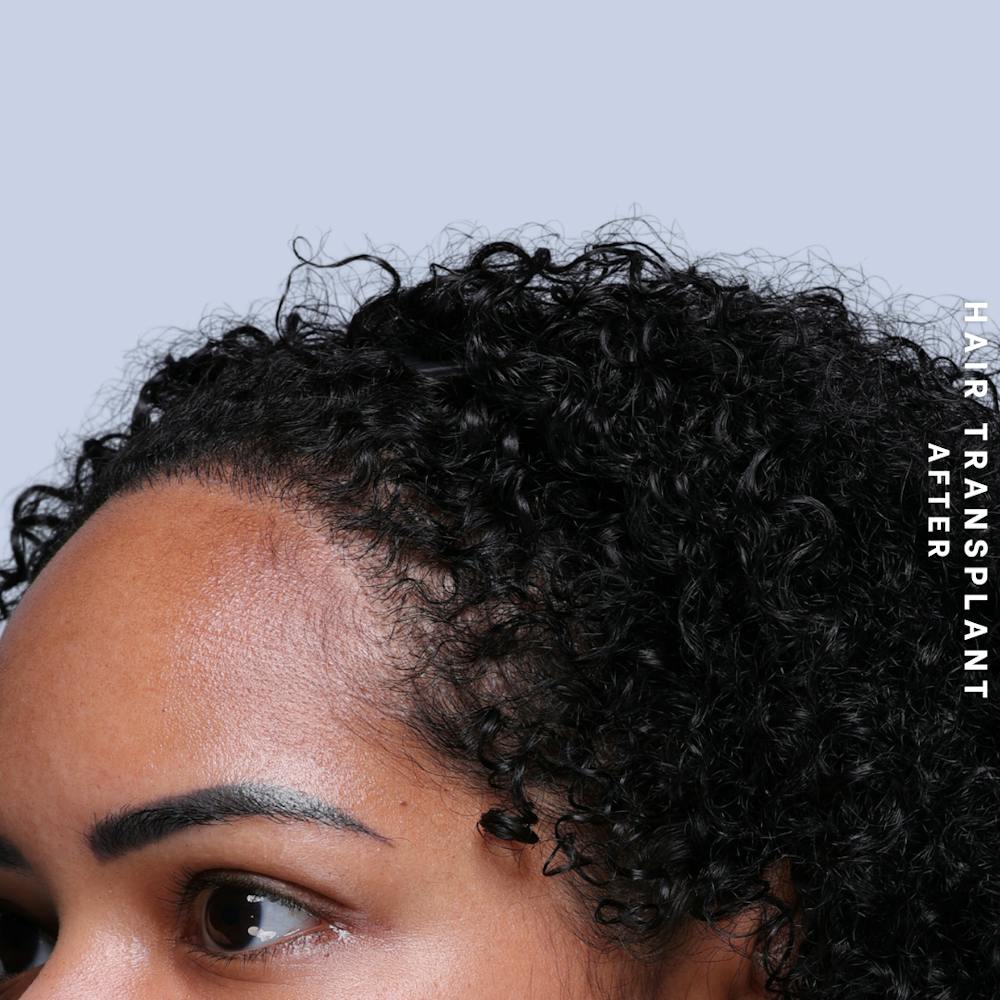 Hair Restoration Before & After Gallery - Patient 109913 - Image 8