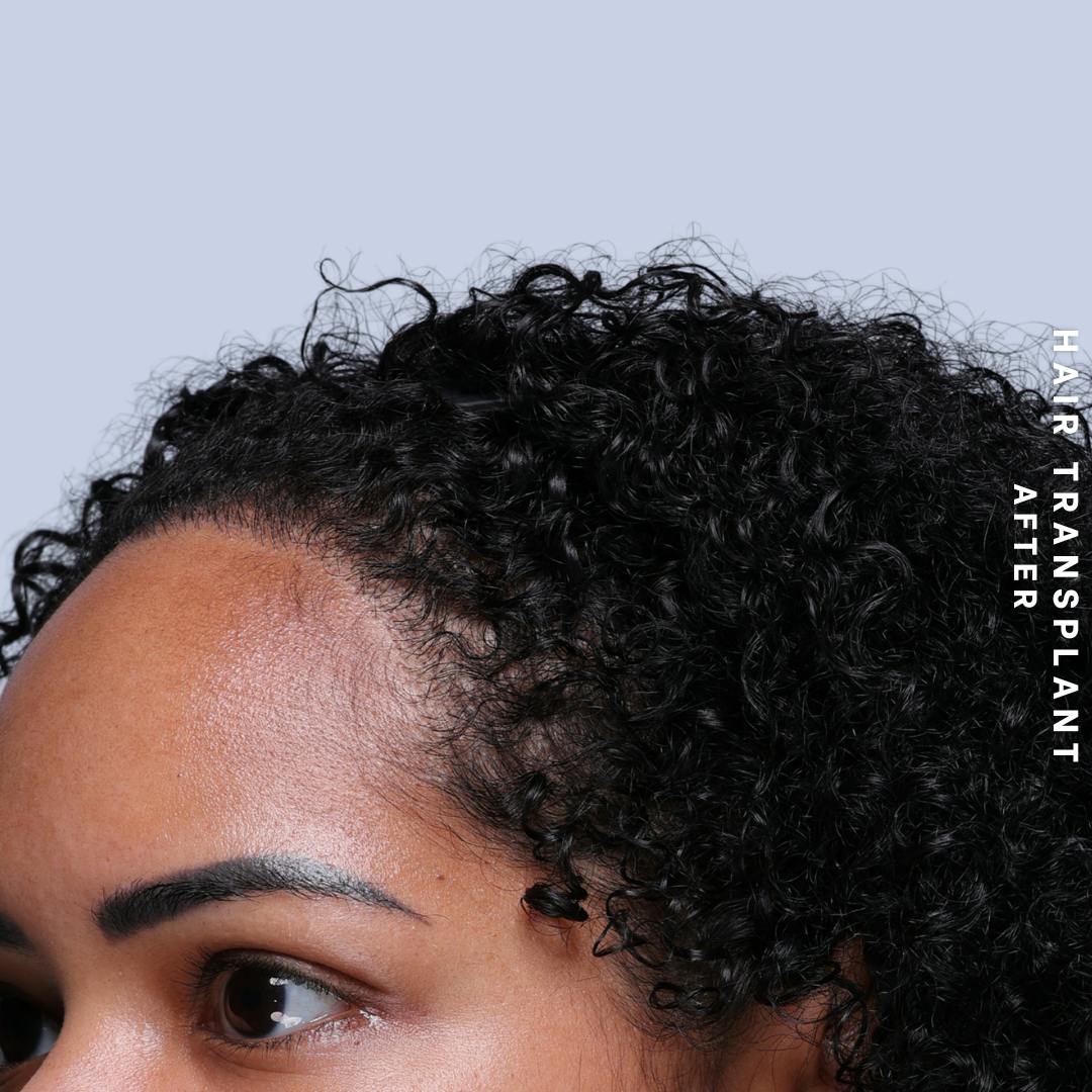 Hair Restoration Before & After Gallery - Patient 109913 - Image 8