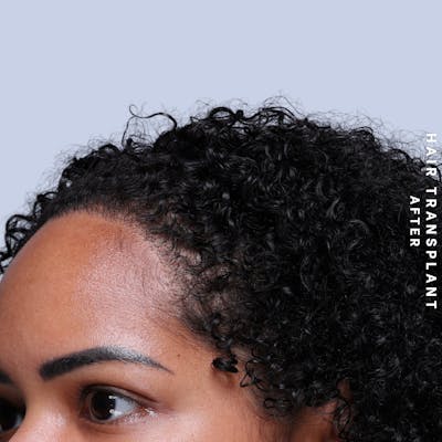 Hair Restoration Before & After Gallery - Patient 109913 - Image 8