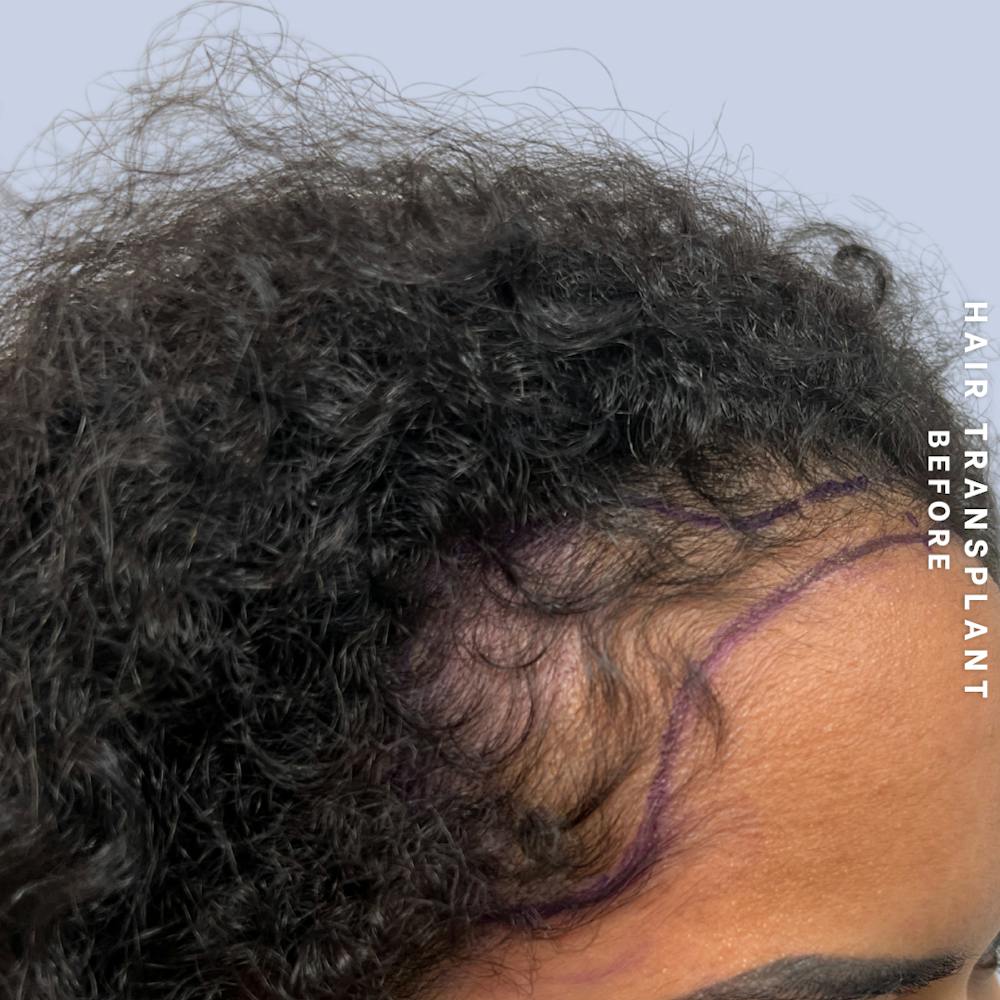 Hair Restoration Before & After Gallery - Patient 109913 - Image 9