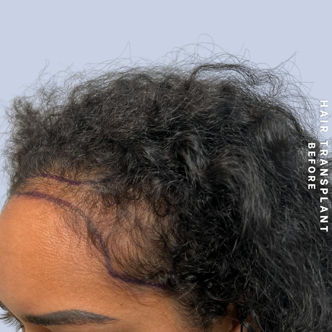 Hair Restoration Before & After Gallery - Patient 109913 - Image 7