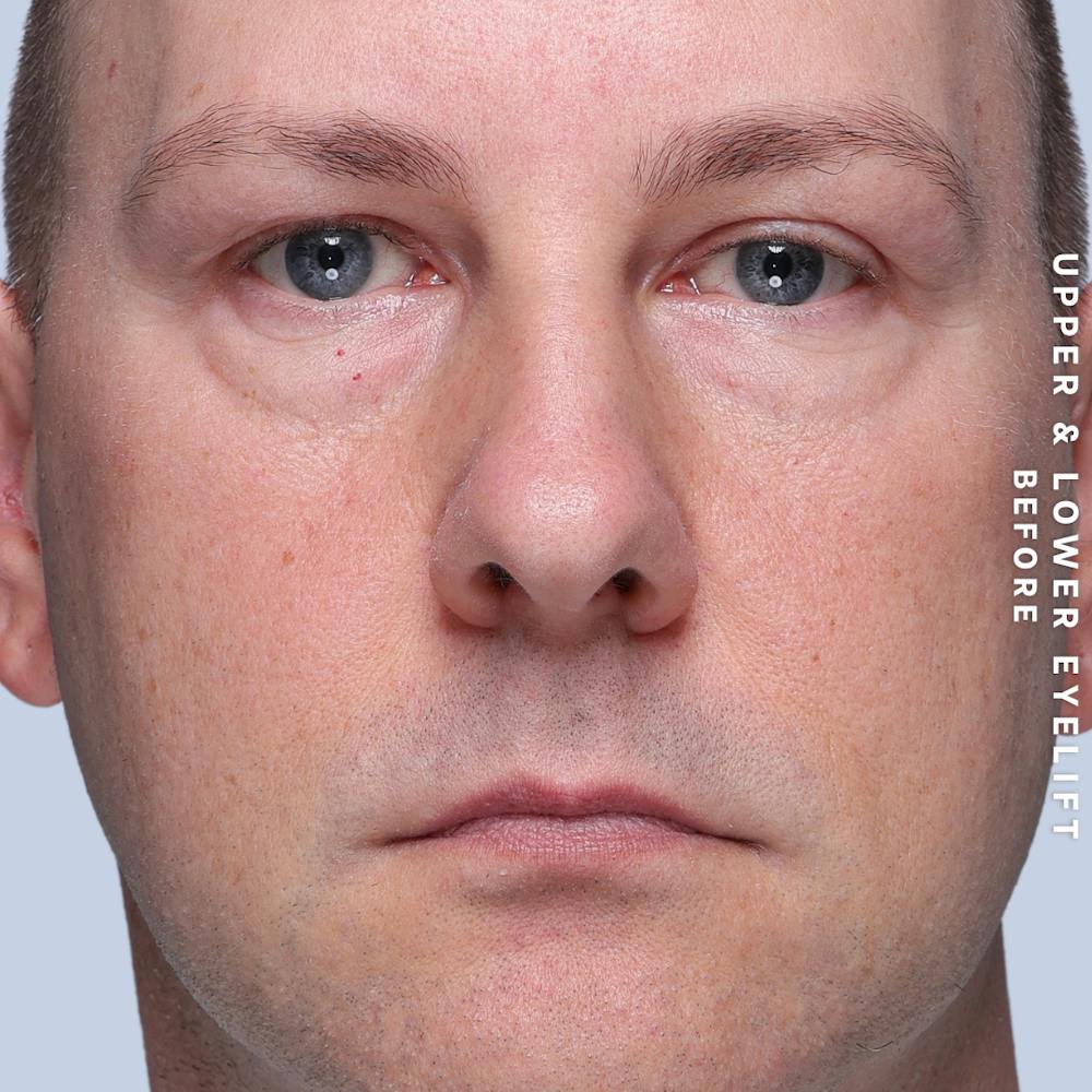 Eyes Before & After Gallery - Patient 407617 - Image 1