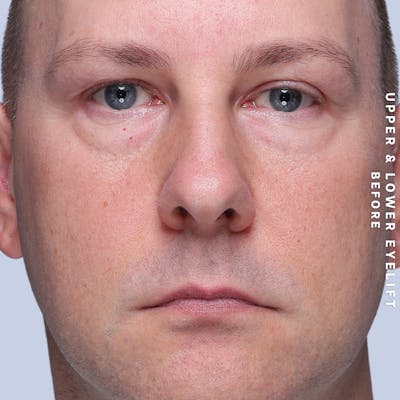 Eyes Before & After Gallery - Patient 407617 - Image 1