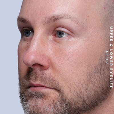 Eyes Before & After Gallery - Patient 407617 - Image 4