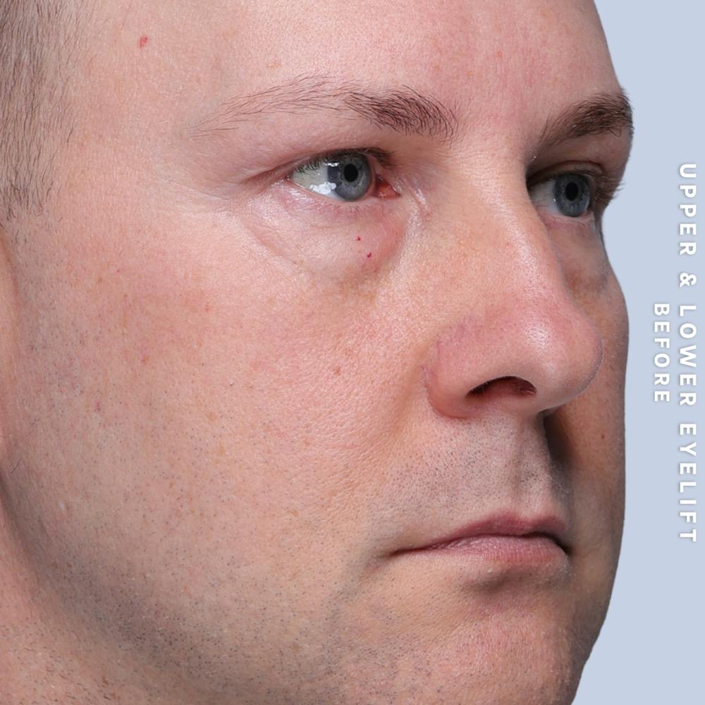 Eyes Before & After Gallery - Patient 407617 - Image 5