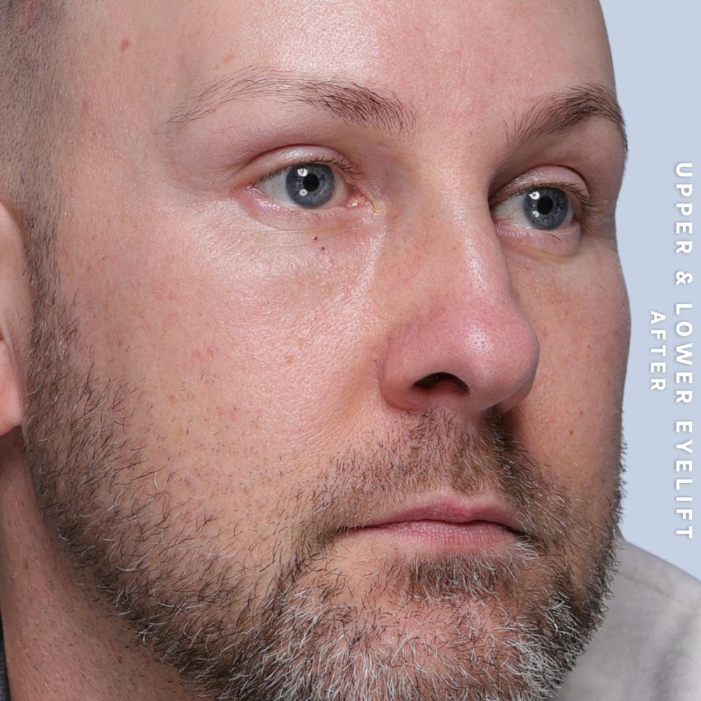 Eyes Before & After Gallery - Patient 407617 - Image 6