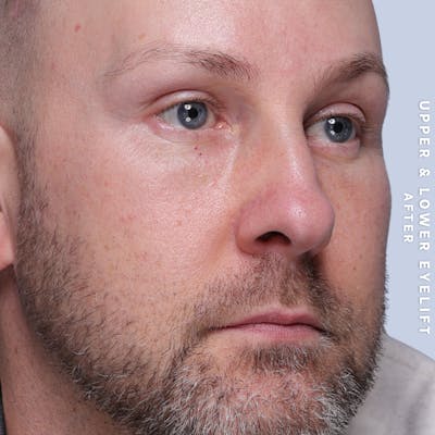 Eyes Before & After Gallery - Patient 407617 - Image 6