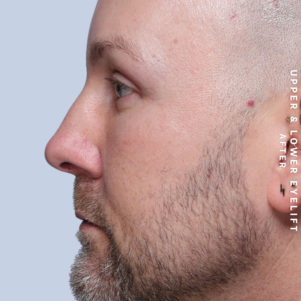 Eyes Before & After Gallery - Patient 407617 - Image 8